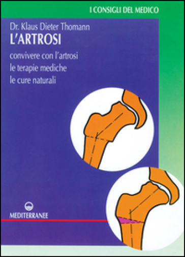 L'artrosi. Come convivere con l'artrosi. Le terapie mediche, le cure individuali - Klaus-Dieter Thomann