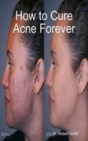 How to Cure Acne Forever