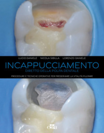 Incappucciamento diretto della polpa dentale. Procedure e tecniche operative per preservar...