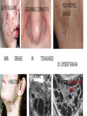 Skin Diseases In Teenages.