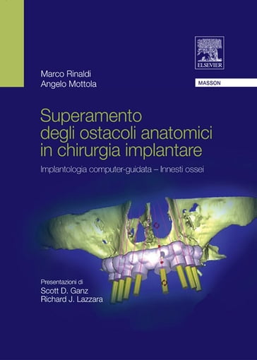 Superamento degli ostacoli anatomici in chiurgia implantare - Angelo Mottola - Marco Rinaldi