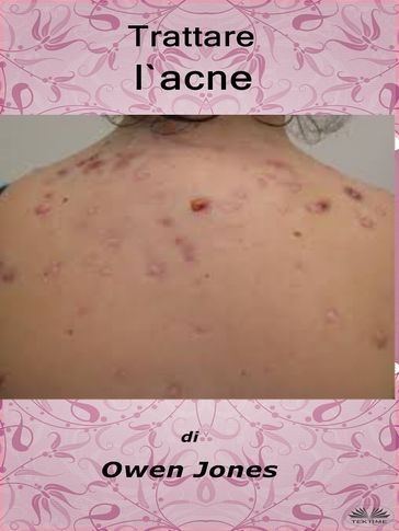 Trattare L'Acne - Jones Owen