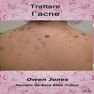 Trattare L'Acne - Jones Owen