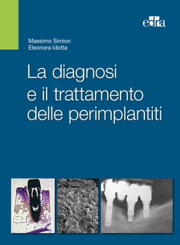 La diagnosi e il trattamento delle perimplantiti - Eleonora Idotta - Massimo Simion